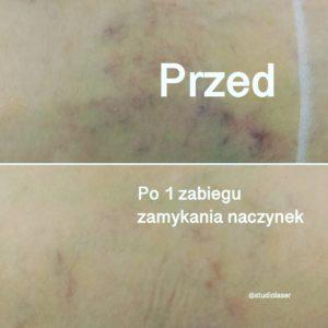 laserowe zamykanie naczynek - efekty