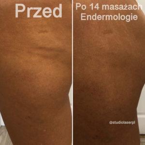 endermologia - efekty po 14 masażach