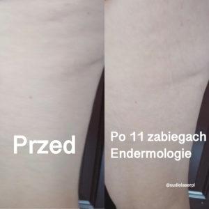 efekt 11 zabiegów endermologii