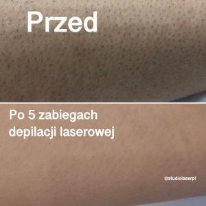 po 5 zabiegach depilacji laserowej