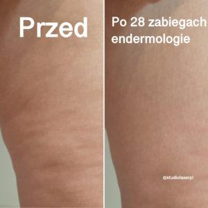 zabieg endermologii - efekty