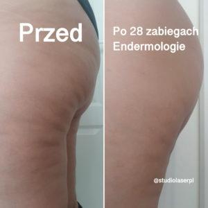 efekty endermologii