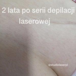 2 lata po depilacji laserowej - efekty