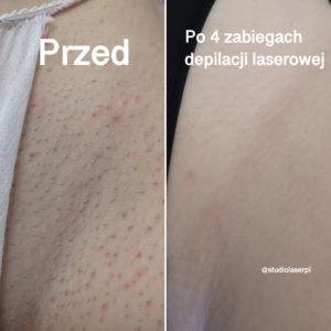 depilacja laserowa - efekt po zabiegu